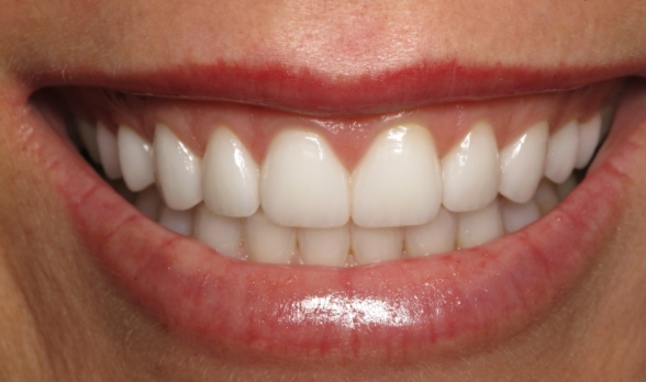 a close up of a woman ' s mouth with a missing tooth