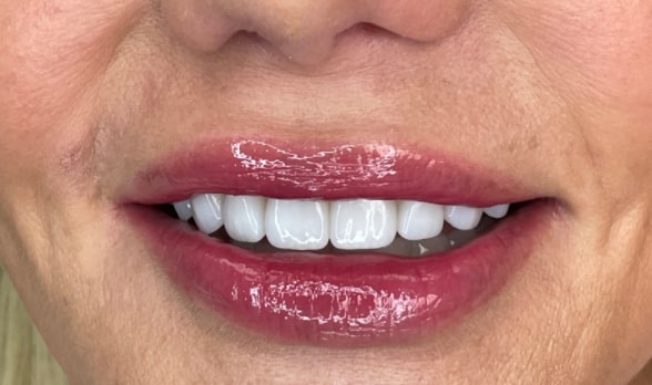 a close up of a woman ' s mouth with a missing tooth