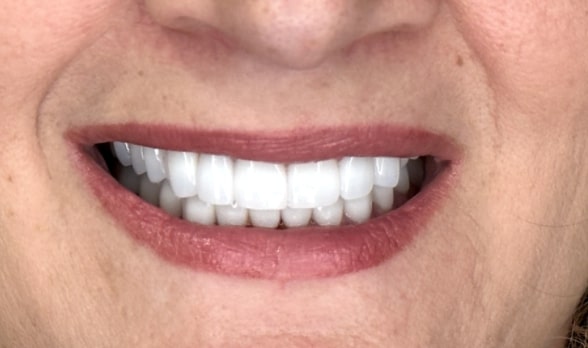 a close up of a woman ' s smile with a missing tooth