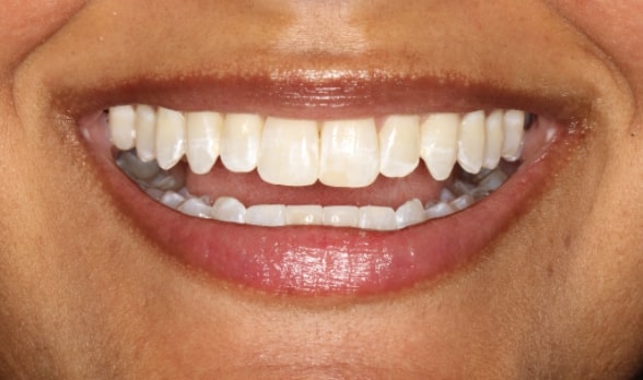 a close up of a person ' s smile with a missing tooth