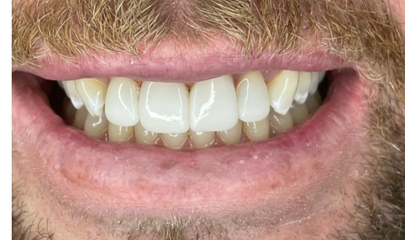 a close up of a man ' s mouth with a missing tooth