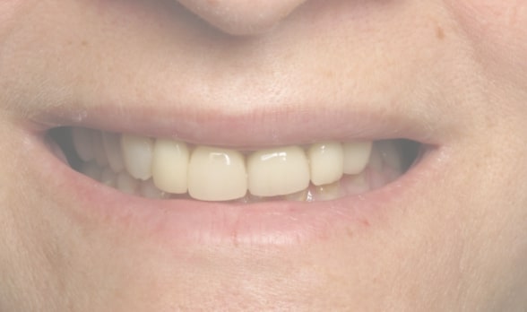 a close up of a woman ' s smile with a missing tooth