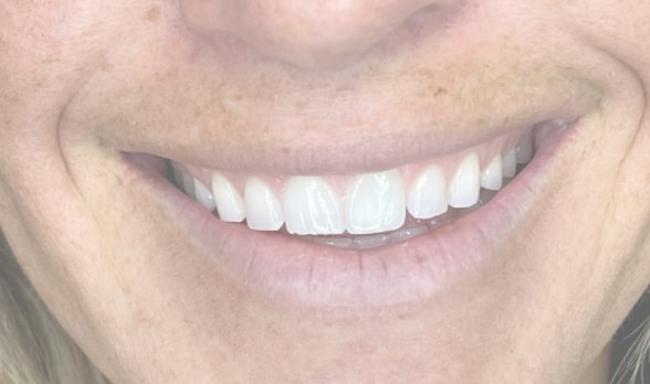 a close up of a woman ' s smile with a tooth brush in her mouth