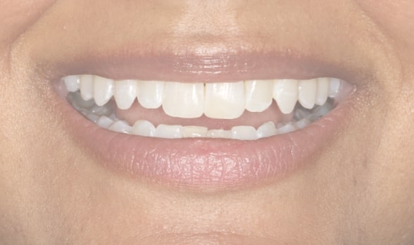 a close up of a person ' s mouth with a missing tooth