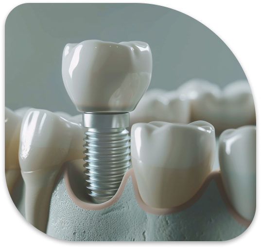 a close up of a tooth with a dental implant in it