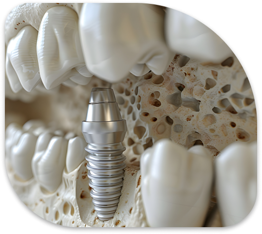 a close up of a dental implant in a tooth with a missing tooth