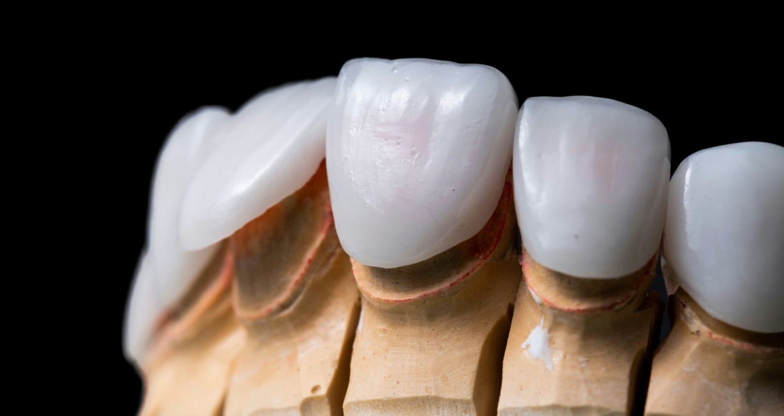 a close up of a tooth with a missing tooth on it