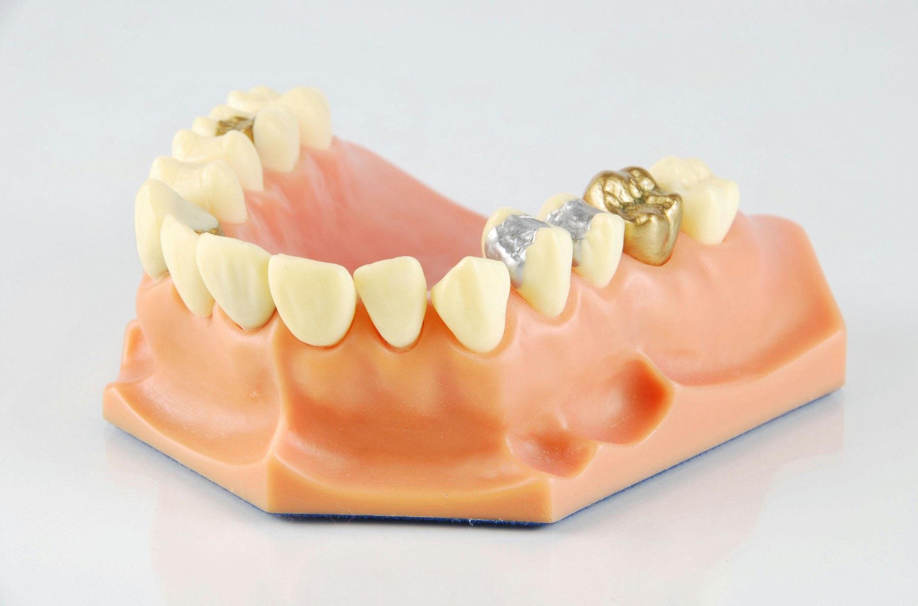 there is a model of a tooth with a gold crown on it