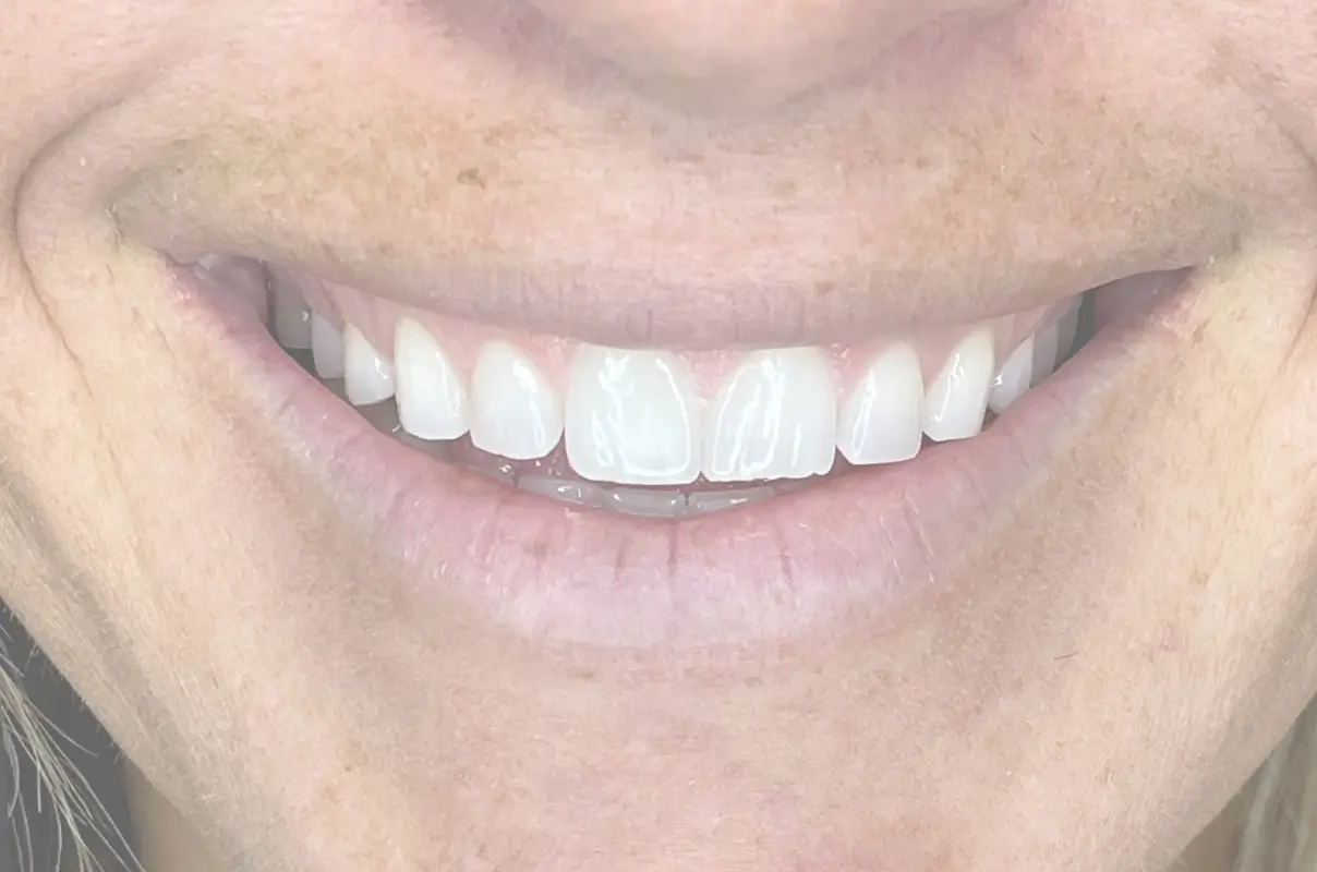 smiling woman with white teeth and white teeth with a toothbrush