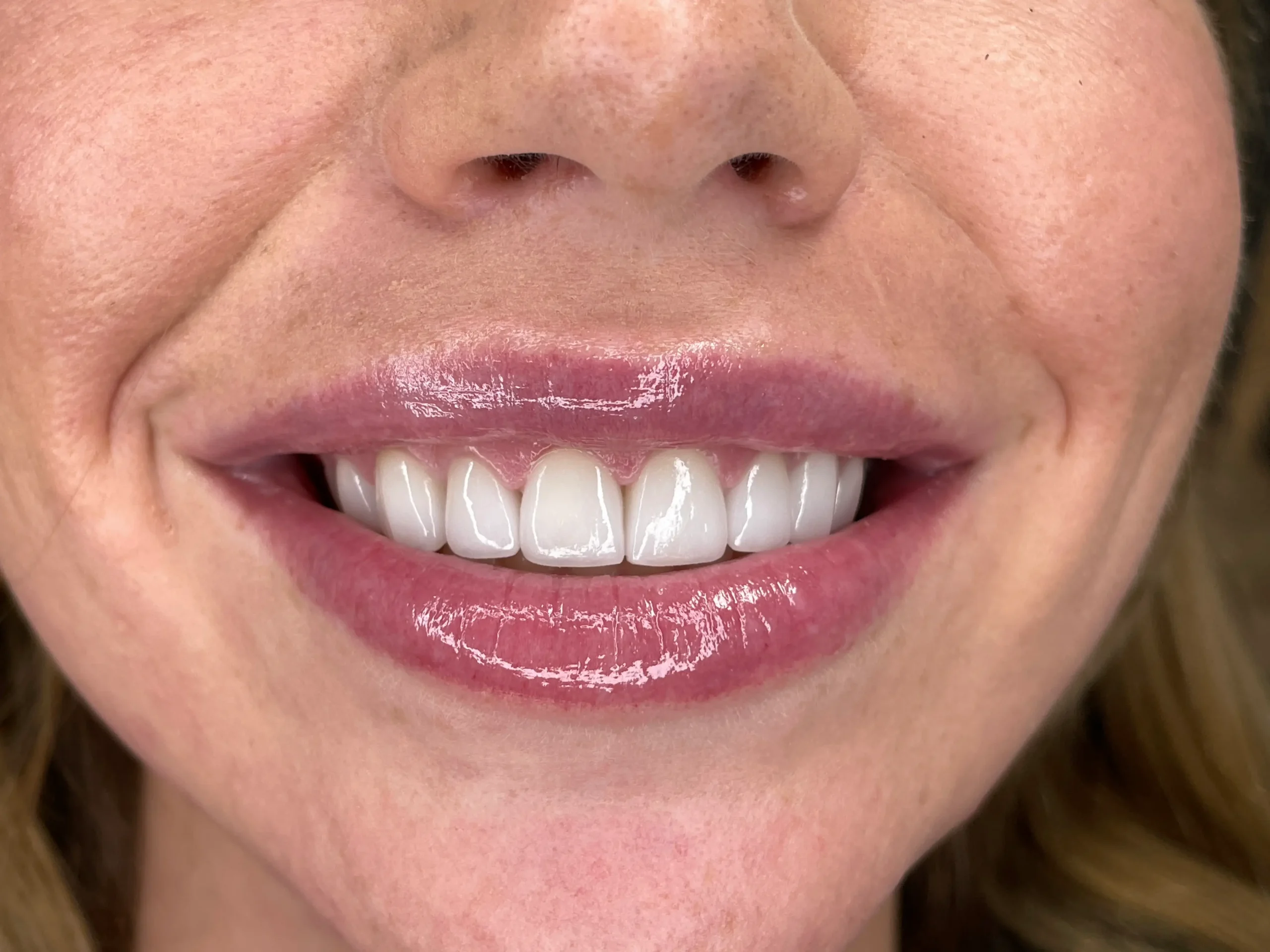 a close up of a woman ' s smile with a missing tooth