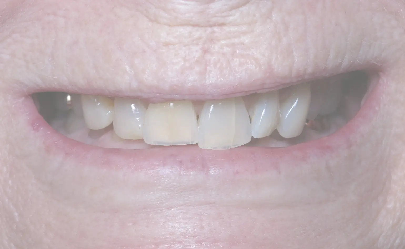 a close up of a person ' s mouth with a missing tooth