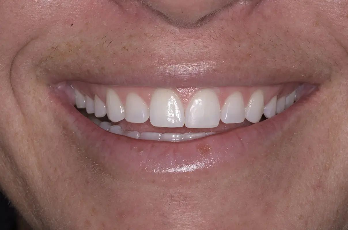 a close up of a person ' s smile with a missing tooth