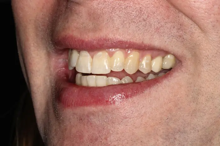 a close up of a person with a missing tooth and missing teeth