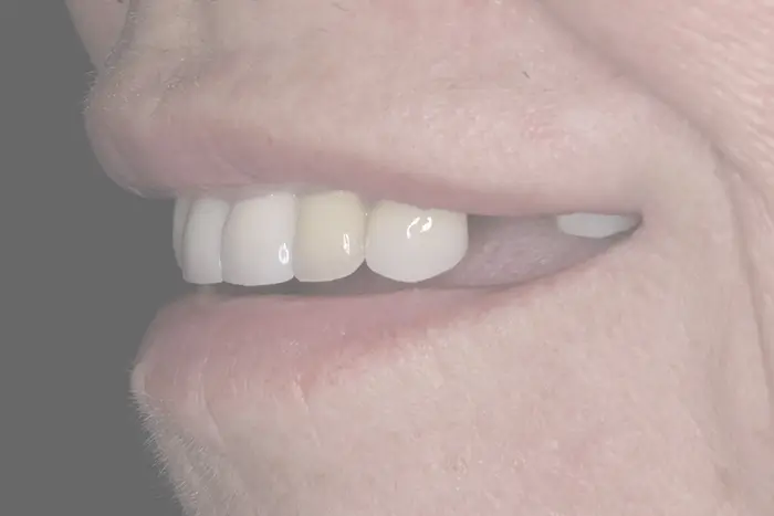 a close up of a woman ' s mouth with a missing tooth