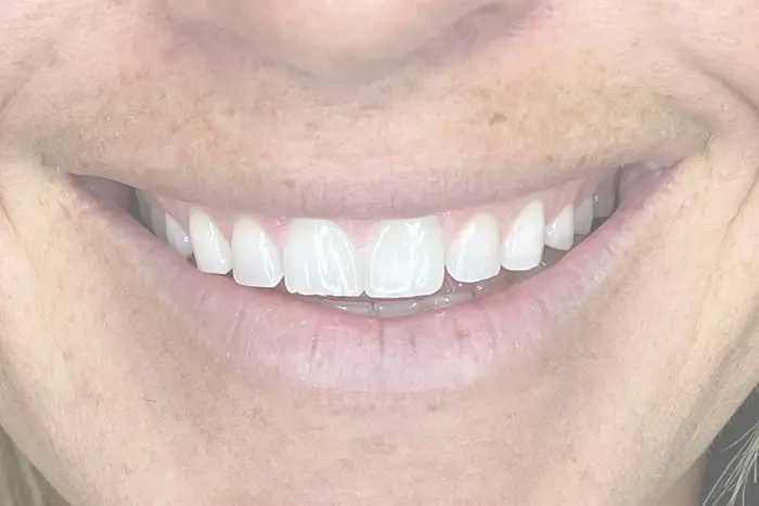 smiling woman with white teeth and a tooth brush in her mouth