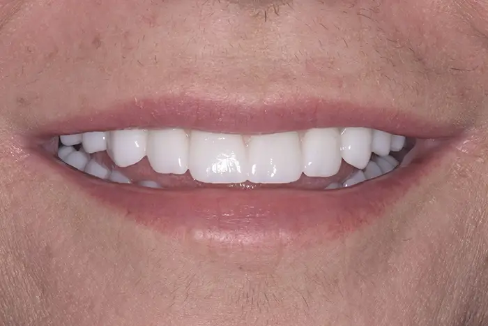 a close up of a man ' s mouth with a missing tooth