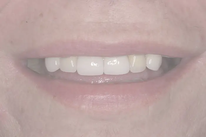 a close up of a man ' s mouth with a missing tooth