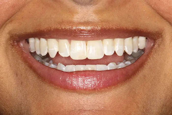 a close up of a person ' s smile with a missing tooth