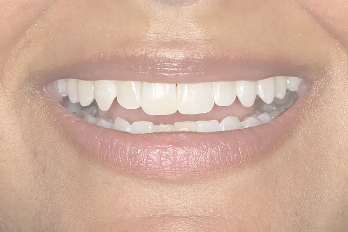 a close up of a person ' s mouth with a missing tooth