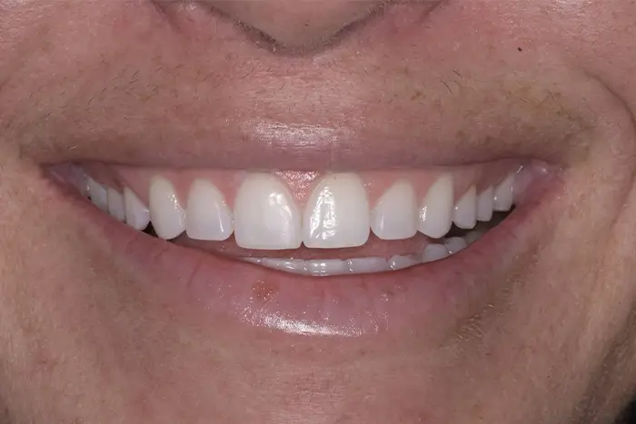 a close up of a person ' s smile with a missing tooth